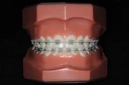 審美ブラケット（セラミックブラケット）